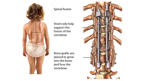 Image Explaining Spinal Fusion Surgery Procedure Image Explaining Spinal Fusion Surgery Procedure